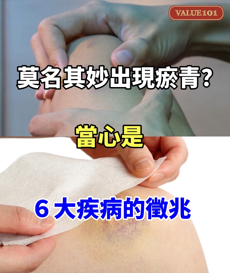 莫名其妙出現瘀青?當心是6大疾病的徵兆