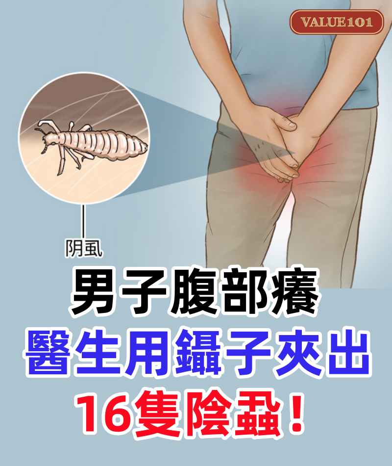 男子腹部癢，醫生用鑷子夾出16隻陰蝨！原來陰蝨有3條傳播途徑